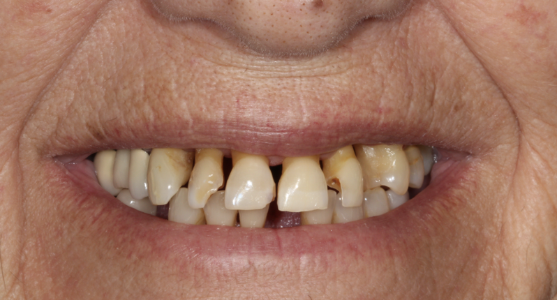 gum-grafting gallery