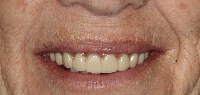 gum-grafting gallery