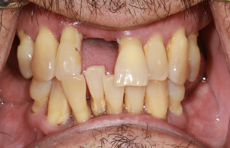 gum-grafting gallery