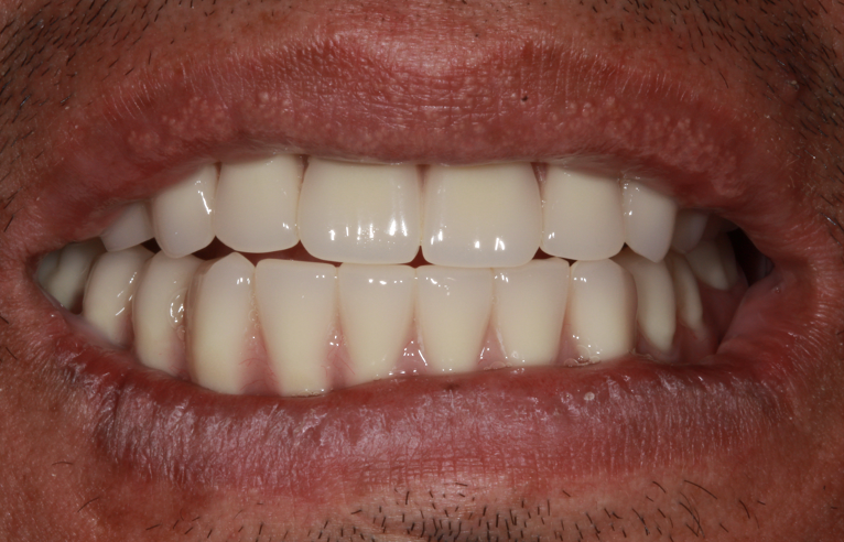 gum-grafting gallery