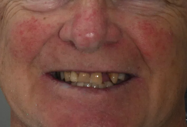 gum-grafting gallery