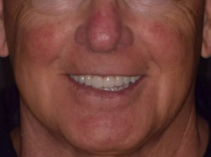 gum-grafting gallery