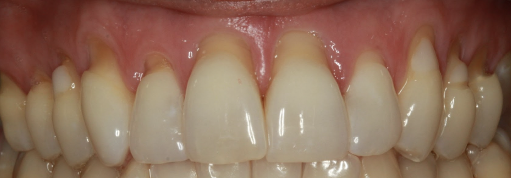 gum-grafting gallery