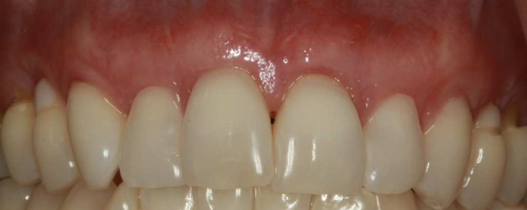 gum-grafting gallery