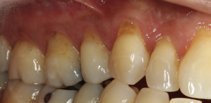 gum-grafting gallery