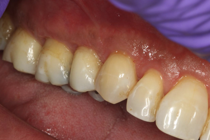 gum-grafting gallery