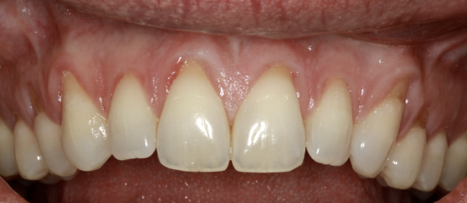 gum-grafting gallery