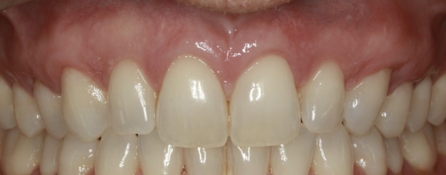 gum-grafting gallery