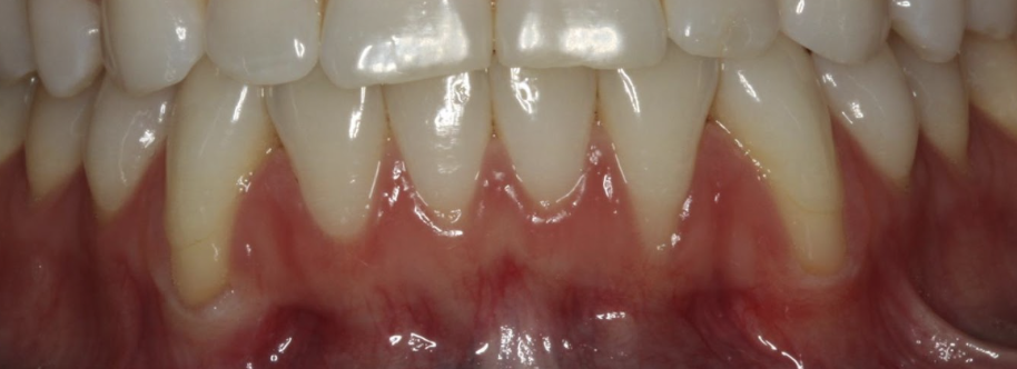 gum-grafting gallery