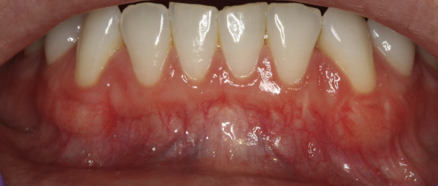 gum-grafting gallery