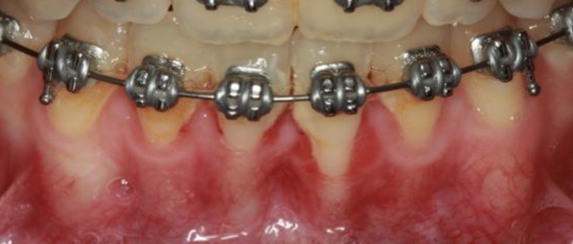 gum-grafting gallery