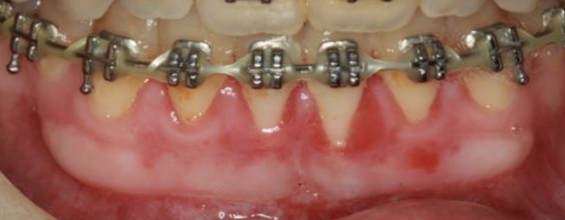 gum-grafting gallery