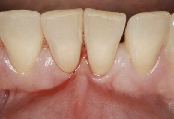 gum-grafting gallery