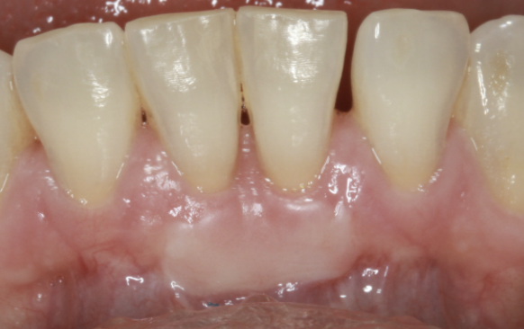 gum-grafting gallery