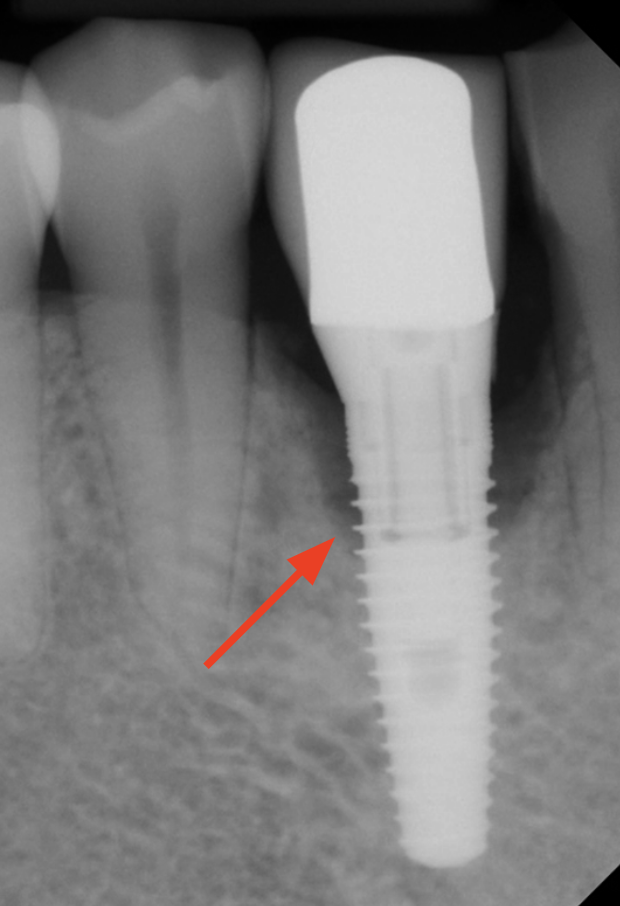 gum-grafting gallery