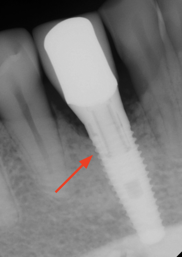 gum-grafting gallery