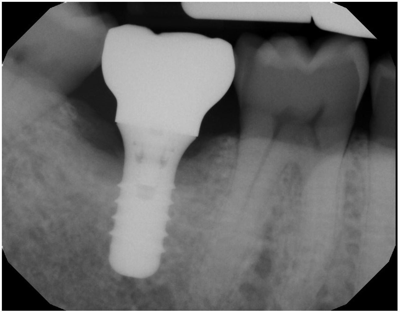 gum-grafting gallery