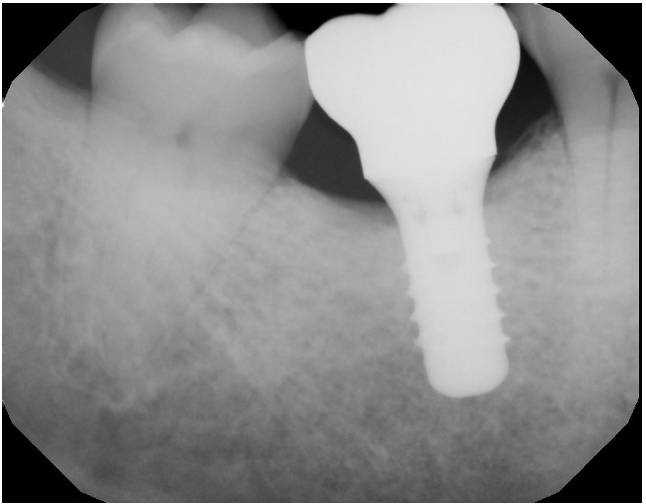 gum-grafting gallery