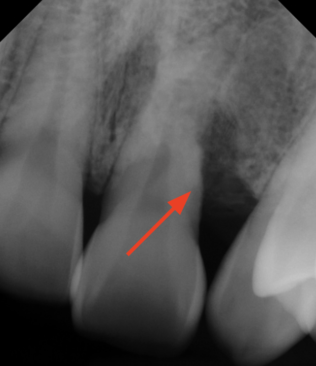 gum-grafting gallery