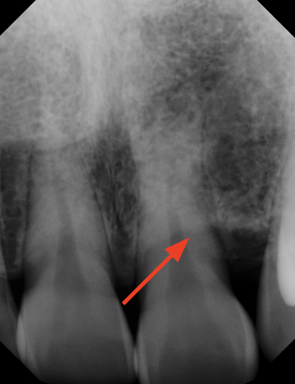 gum-grafting gallery