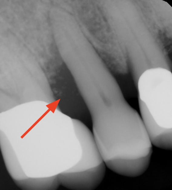 gum-grafting gallery