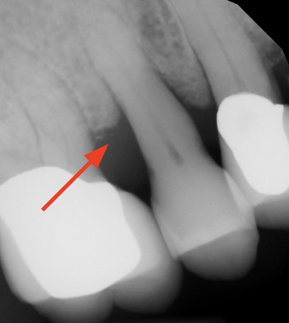 gum-grafting gallery
