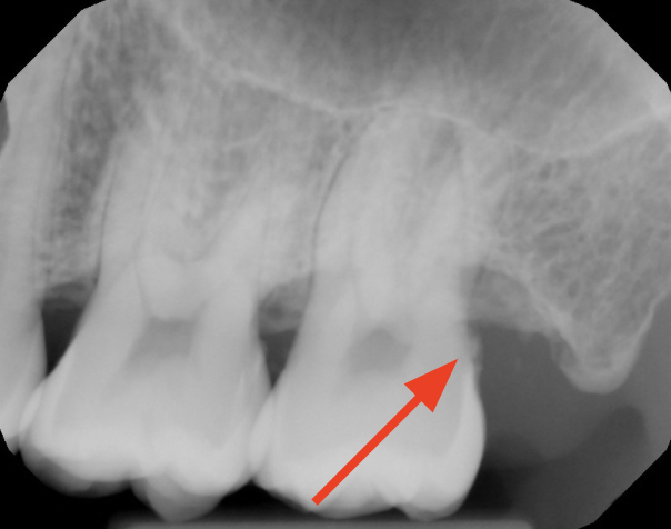 gum-grafting gallery