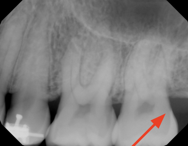 gum-grafting gallery