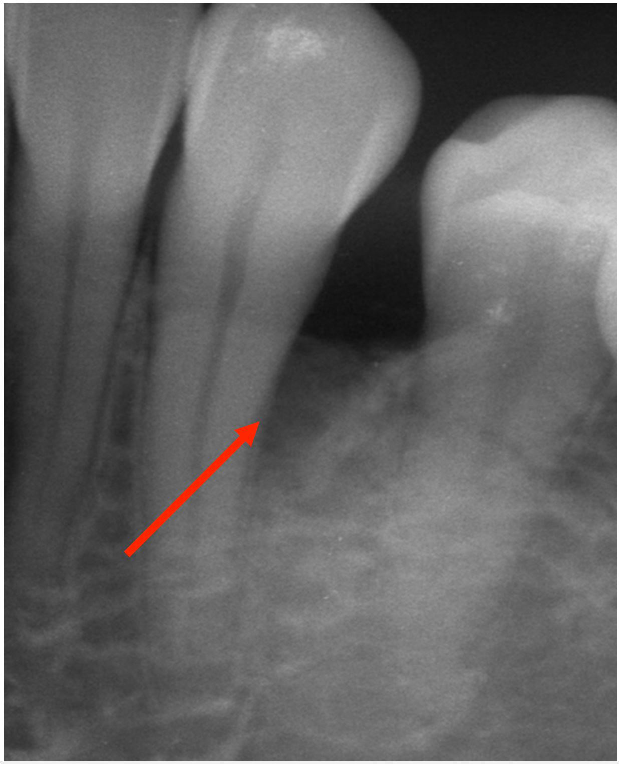 gum-grafting gallery