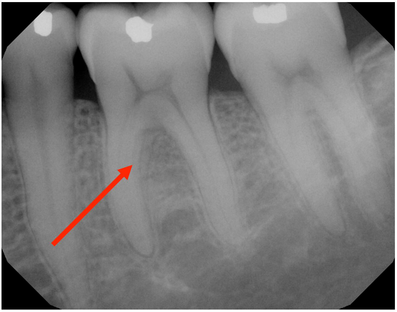 gum-grafting gallery