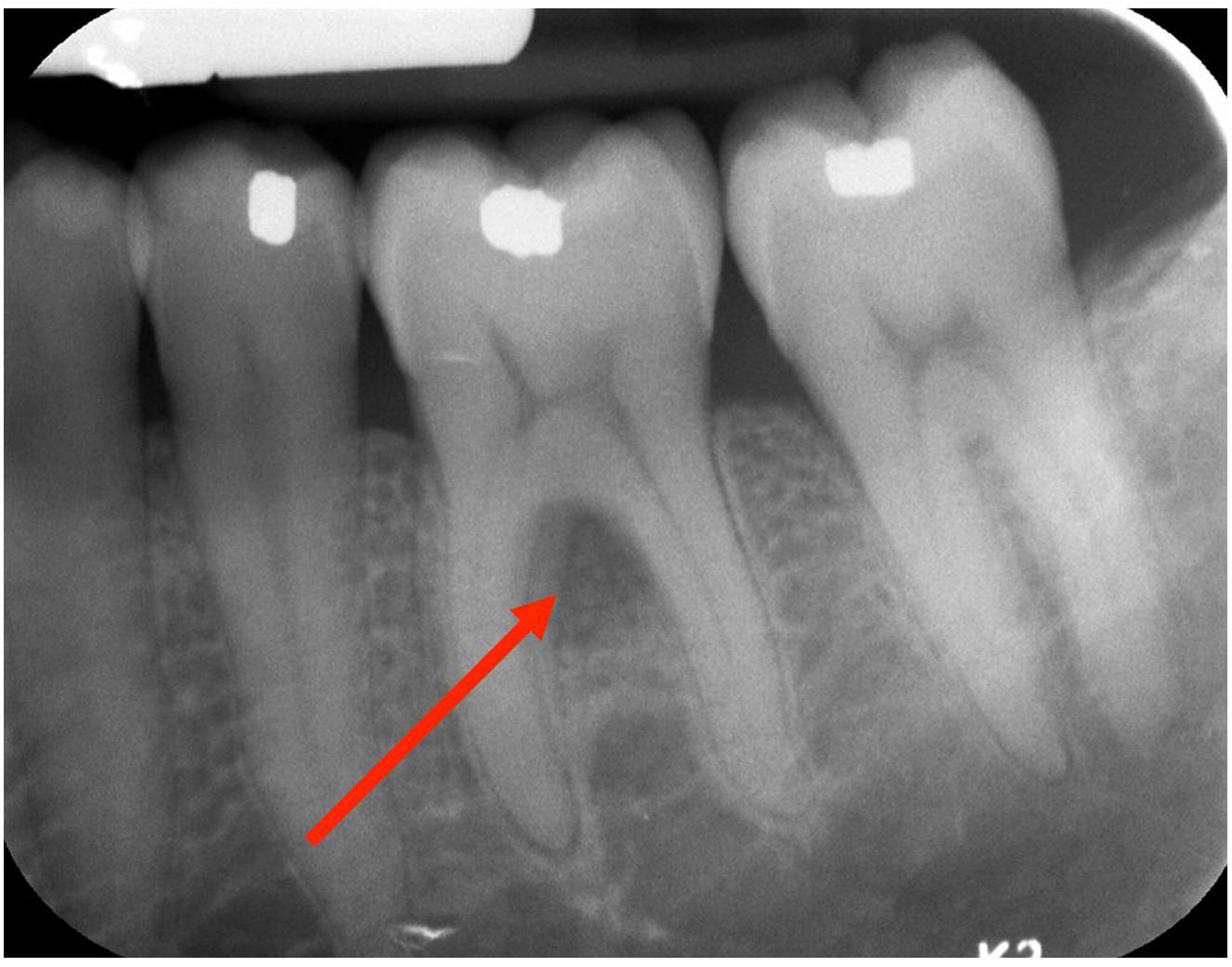 gum-grafting gallery