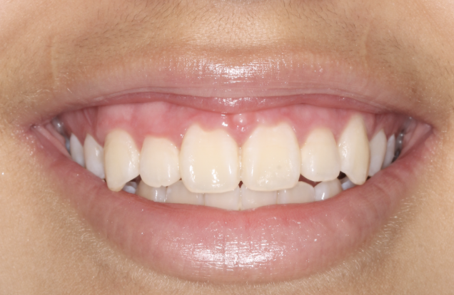 gum-grafting gallery