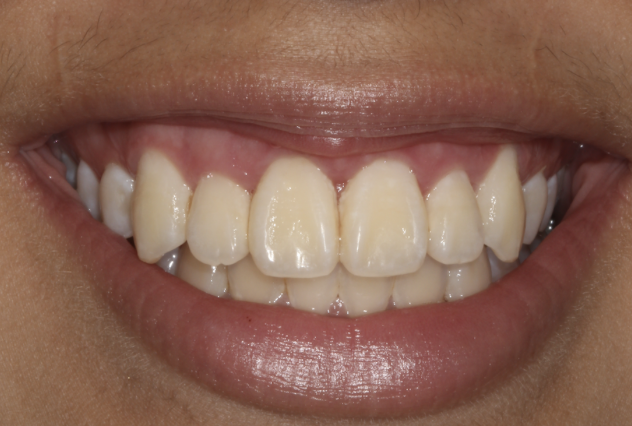 gum-grafting gallery