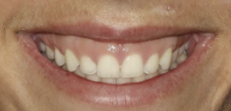 gum-grafting gallery