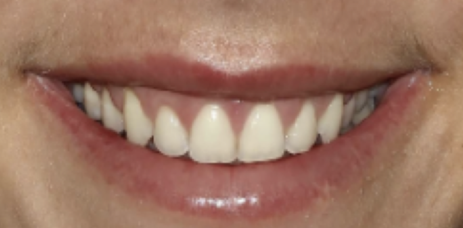 gum-grafting gallery