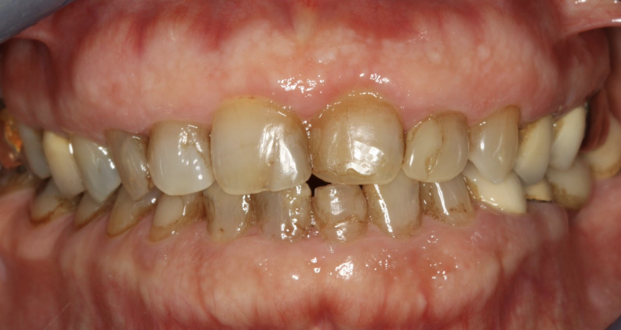 gum-grafting gallery