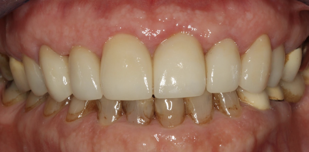 gum-grafting gallery