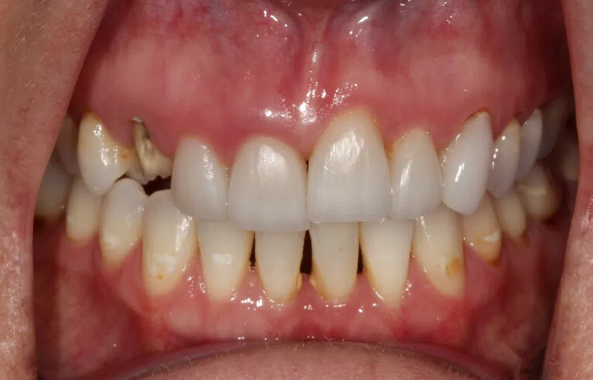 gum-grafting gallery