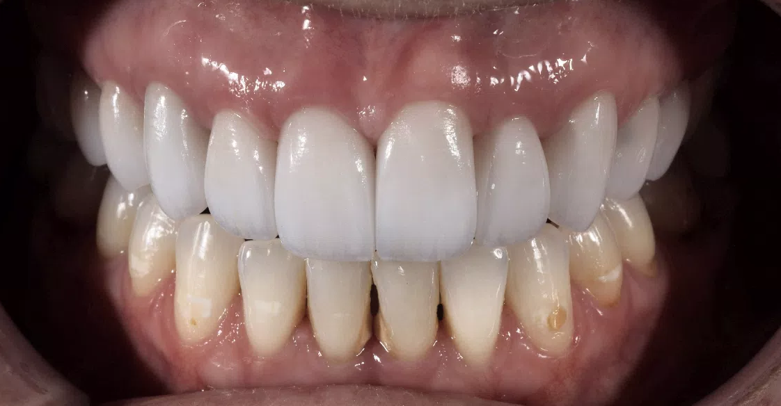 gum-grafting gallery