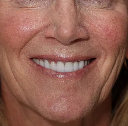 gum-grafting gallery